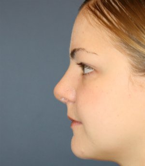 Rhinoplasty San Diego 73 - after - front