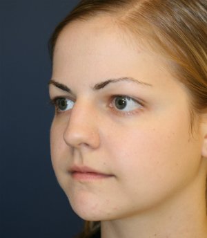 Rhinoplasty San Diego 73 - before - oblique