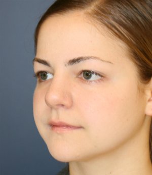 Rhinoplasty San Diego 73 - after - oblique