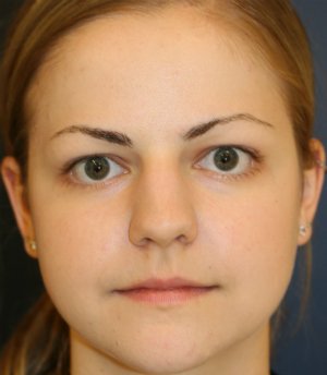 Rhinoplasty San Diego 73 - before - side