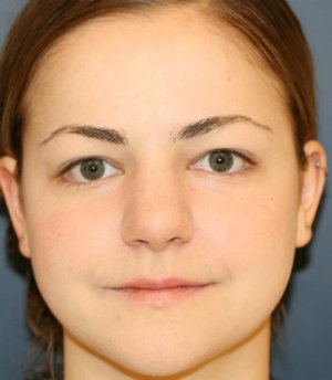 Rhinoplasty San Diego 73 - after - side