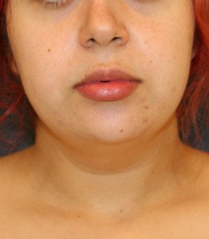 Neck Liposuction and Weight Loss - before - side