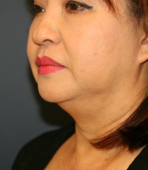 Lipo Neck - before - oblique
