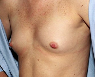 Breast Augmentation Case 17 - before - angle