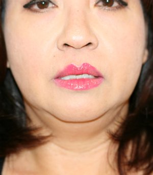 Lip & Corner Lift 151 - before - front