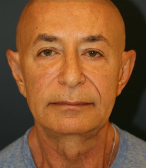 Lip, Corner, and Nasolabial Folds - before - front