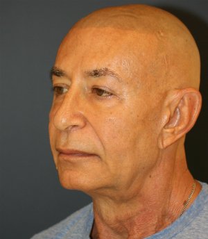 Lip, Corner, and Nasolabial Folds - before - oblique