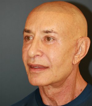 Lip, Corner, and Nasolabial Folds - after - oblique