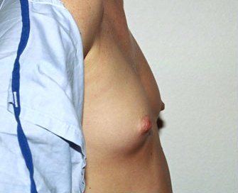 Breast Augmentation Case 17 - before - side