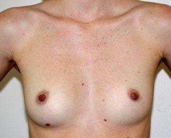 Breast Augmentation Case 18 - before - front