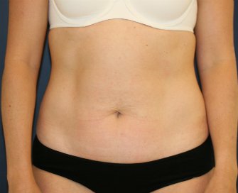 Tummy Tuck San Diego 100 - before - oblique