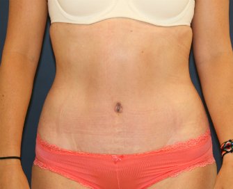 Tummy Tuck San Diego 100 - after - oblique
