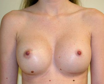 Breast Augmentation Case 18 - after - front