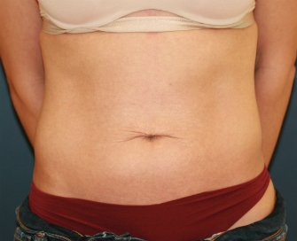 Tummy Tuck San Diego 101 - before - front