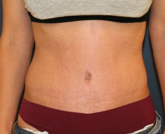 Tummy Tuck San Diego 101 - after - front
