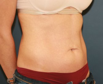 Tummy Tuck San Diego 101 - before - oblique