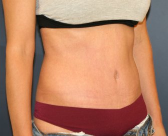 Tummy Tuck San Diego 101 - after - oblique