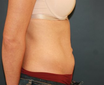 Tummy Tuck San Diego 101 - before - side