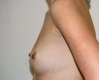 Breast Augmentation Case 18 - before - side