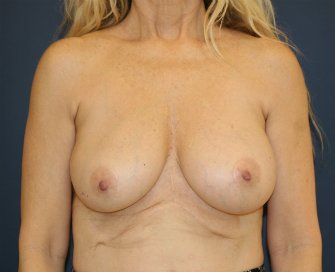 Deflated right implant replaced - before - front