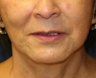 Upper Lip Lift Chin Implant - before - front