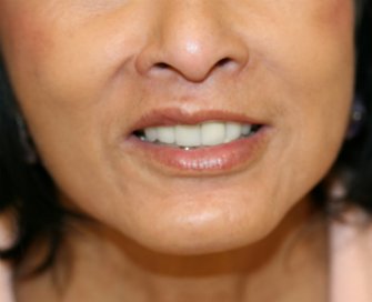 Upper Lip Lift Chin Implant - after - front