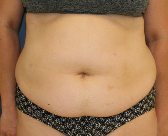 Tummy Tuck San Diego 102 - before - front