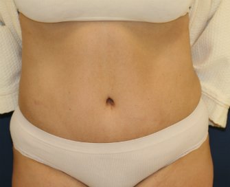 Tummy Tuck San Diego 102 - after - front