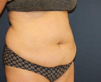 Tummy Tuck San Diego 102 - before - oblique