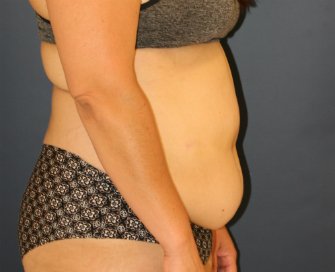 Tummy Tuck San Diego 102 - before - side