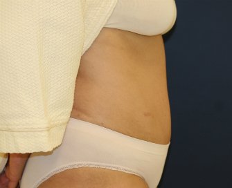 Tummy Tuck San Diego 102 - after - side