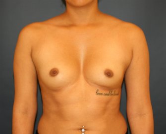 Breast Augmentation TMPX 405 - before - front