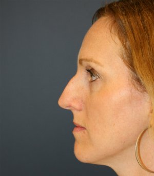 Rhinoplasty (bump on nose) - before - front