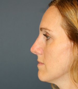 Rhinoplasty (bump on nose) - after - front