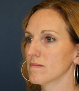 Rhinoplasty (bump on nose) - before - oblique