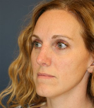 Rhinoplasty (bump on nose) - after - oblique