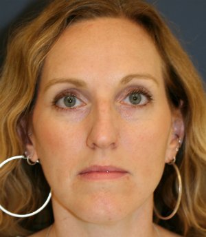 Rhinoplasty (bump on nose) - before - side