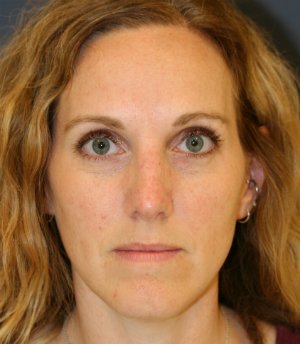 Rhinoplasty (bump on nose) - after - side