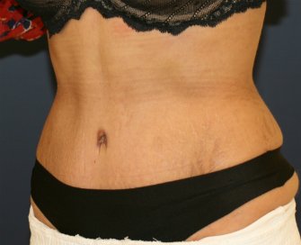 Tummy Tuck San Diego 103 - after - front