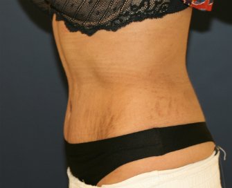Tummy Tuck San Diego 103 - after - oblique