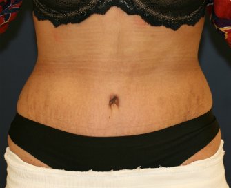 Tummy Tuck San Diego 103 - after - side