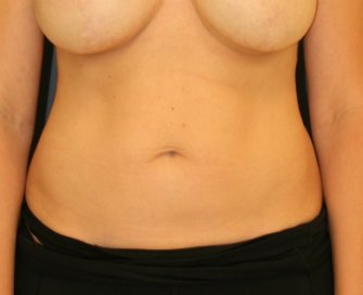 Mini-Tummy-Tuck-10 - before - front