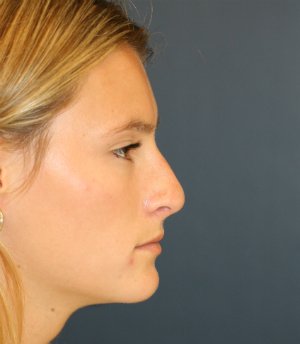 Rhinoplasty teen-age San Diego - before - front