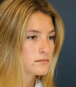 Rhinoplasty teen-age San Diego - before - oblique