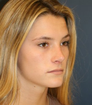 Rhinoplasty teen-age San Diego - after - oblique