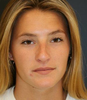 Rhinoplasty teen-age San Diego - before - side