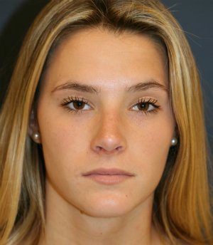 Rhinoplasty teen-age San Diego - after - side
