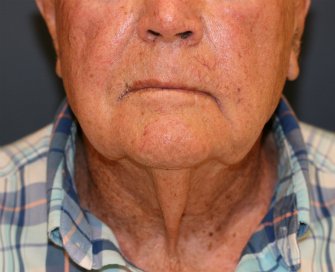 Male \"Turkey Gobbler\" Neck Lift - before - side