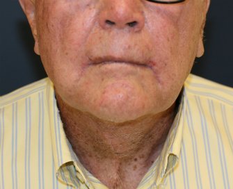 Male \"Turkey Gobbler\" Neck Lift - after - side