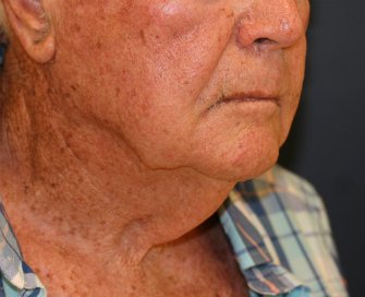 Male \"Turkey Gobbler\" Neck Lift - before - oblique